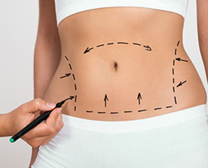 liposuction